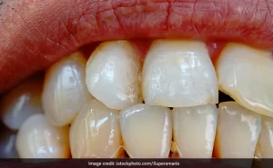 k4ptuulo_strong-teeth-and-yellow-teeth-home-remedies_625x300_05_July_22-300x185 #1 पीले दांतों से अब और ज्यादा नहीं होना पड़ेगा परेशान, इन 5 घरेलू नुस्खों से मोती जैसे चमकने लगेंगे Yellow Teeth