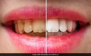 n9eieqc8_teeth-whitening-at-home_625x300_02_February_22-300x185 #1 पीले दांतों से अब और ज्यादा नहीं होना पड़ेगा परेशान, इन 5 घरेलू नुस्खों से मोती जैसे चमकने लगेंगे Yellow Teeth