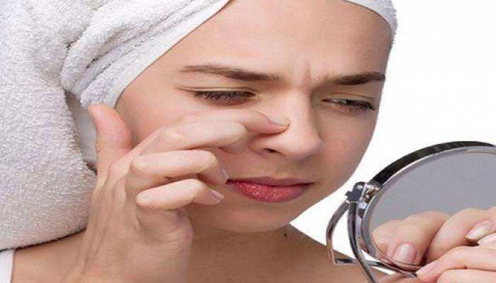 blackheads